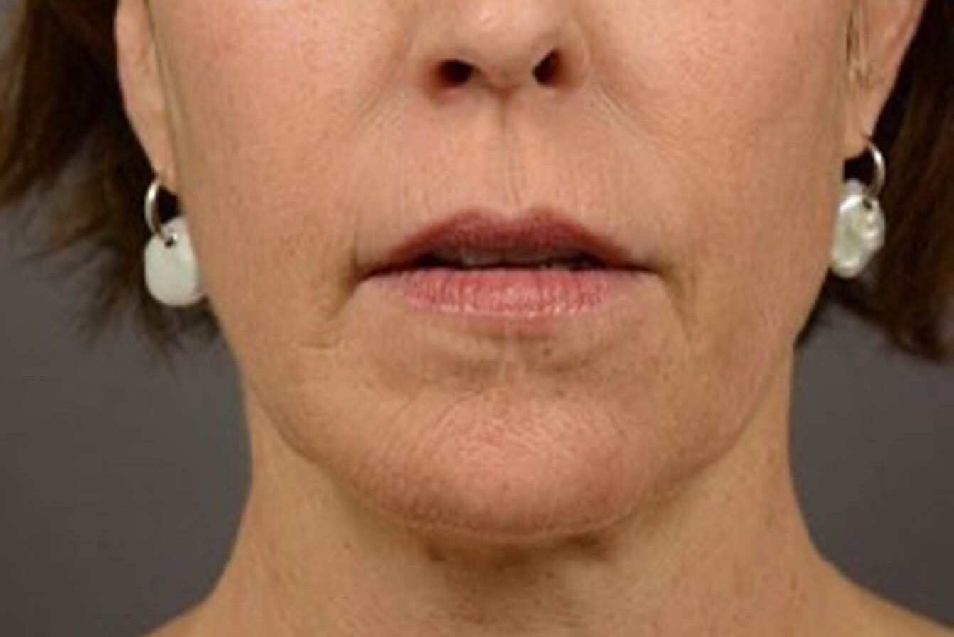 Huidbehandeling bij SKINSIS Clinic