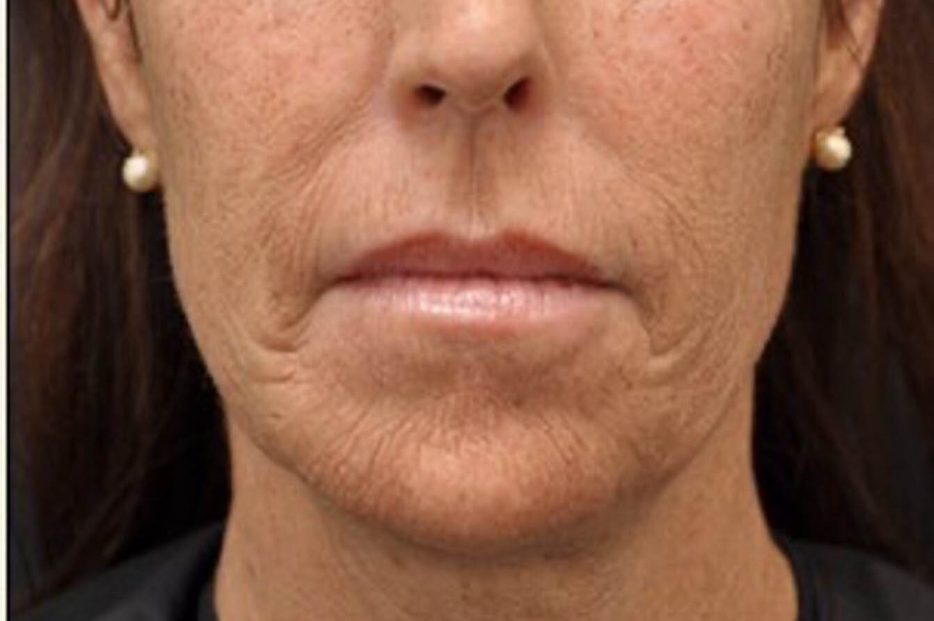 Huidbehandeling bij SKINSIS Clinic