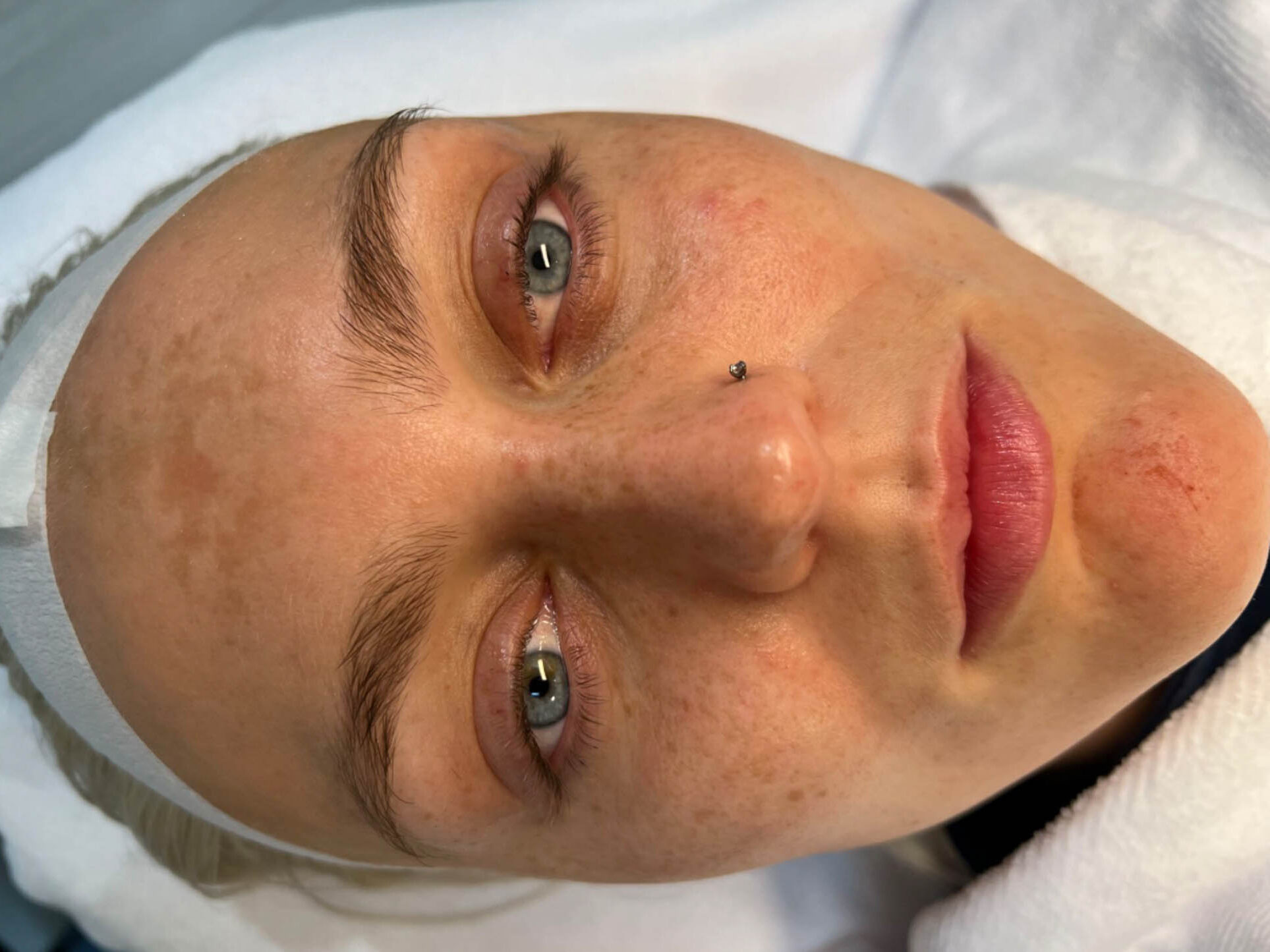Huidbehandeling bij SKINSIS Clinic