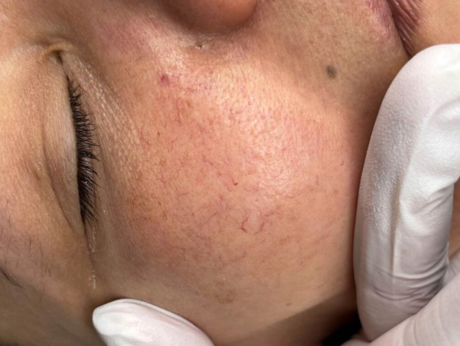 Huidbehandeling bij SKINSIS Clinic