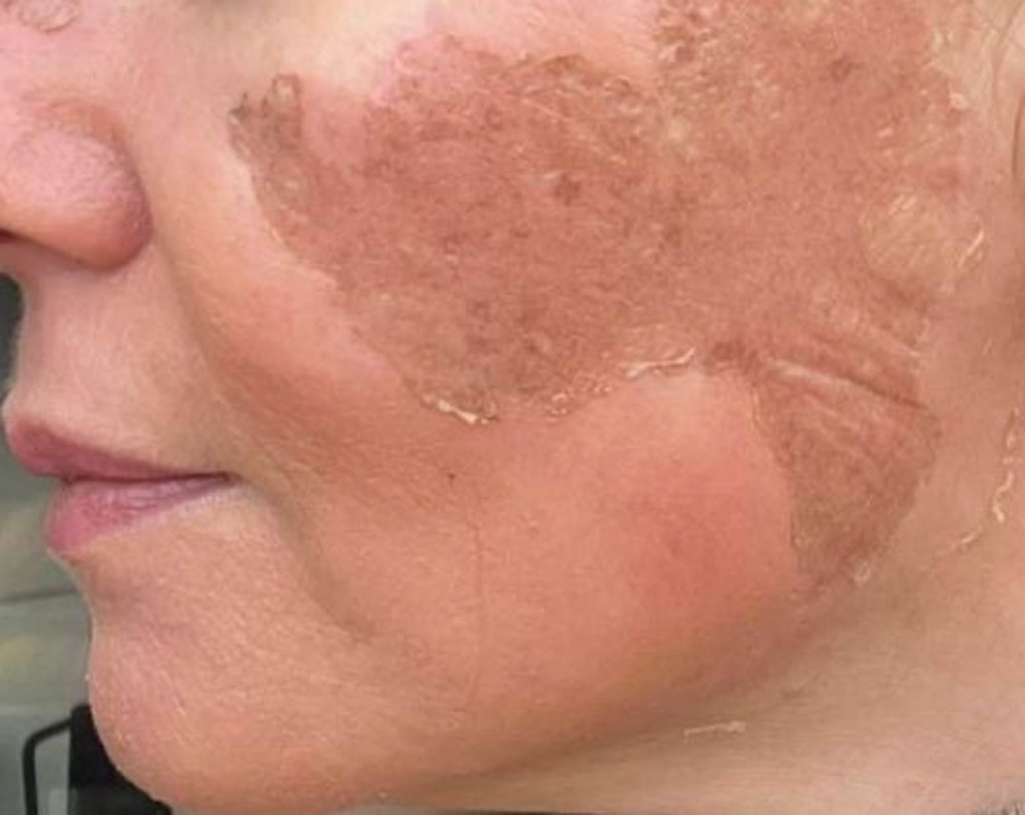 Huidbehandeling bij SKINSIS Clinic