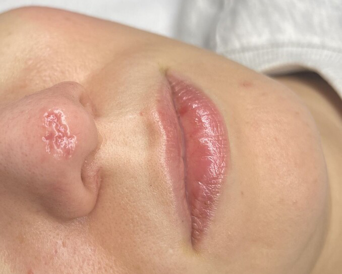 Huid na littekenbehandeling — resultaat A2