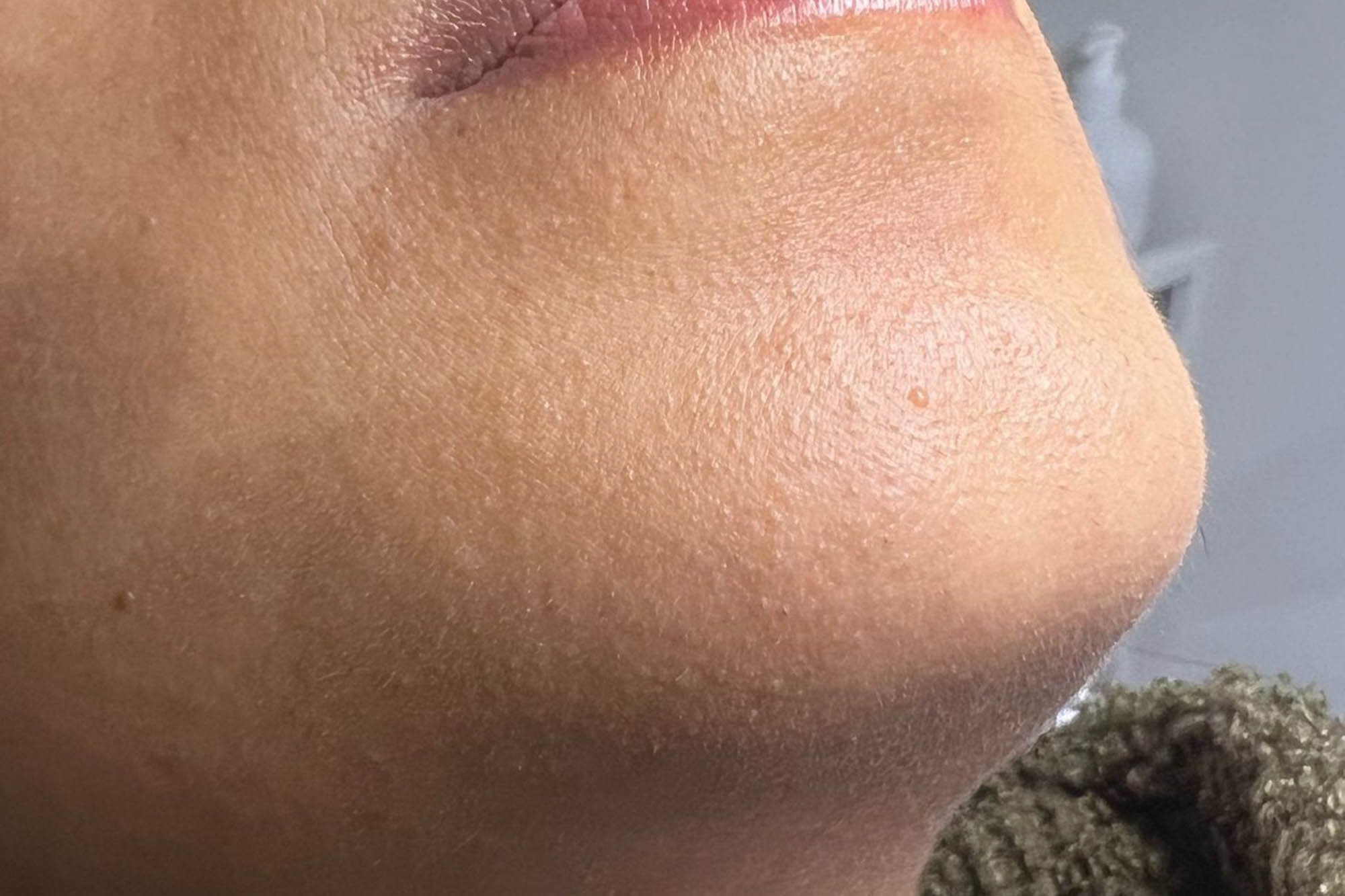 Huid na laserontharen — resultaat B2