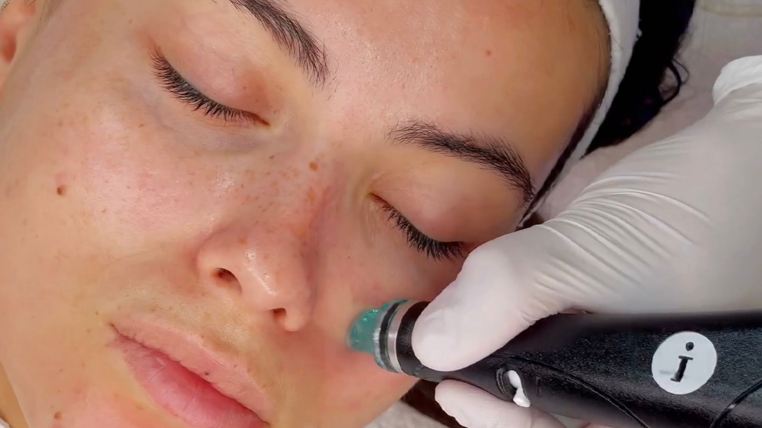 HYDRAFACIAL