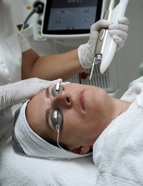 Fotona 5D laserbehandeling tegen roodheden bij SKINSIS