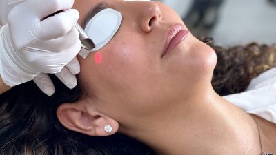 Fotona SmoothEye behandeling, onderdeel van SKINSIS membership