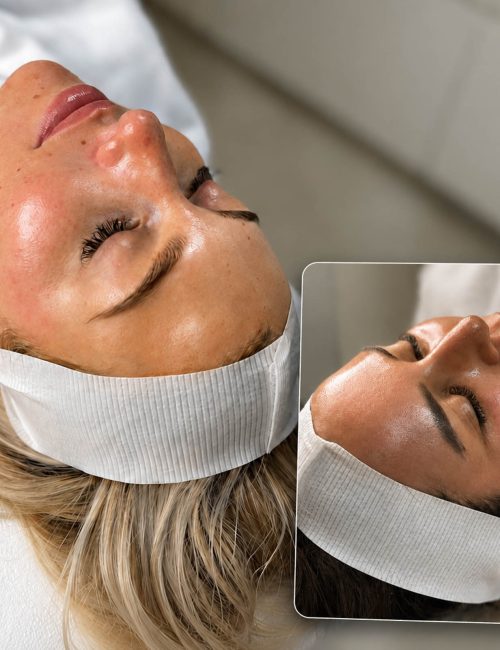 Huidbehandeling bij SKINSIS Clinic