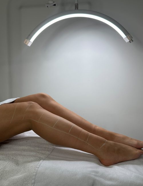 Laserontharen behandeling bij SKINSIS Clinic