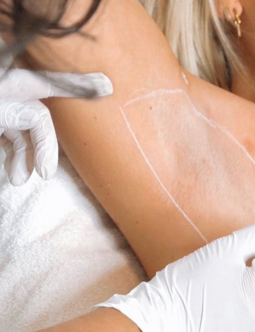 Laserontharen behandeling bij SKINSIS Clinic