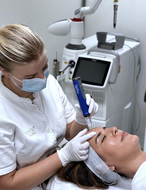 SkinPen microneedling behandeling tegen littekens bij SKINSIS